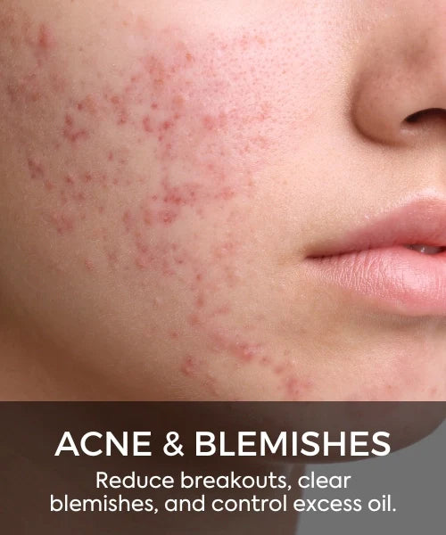 Acne & Blemishes