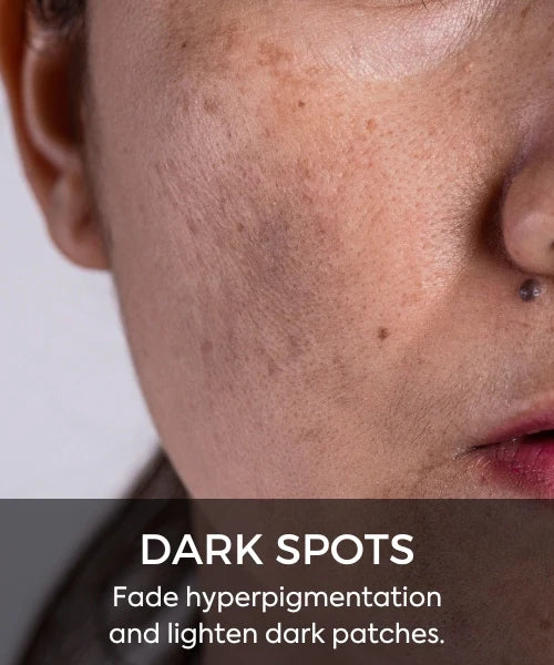 Dark Spots